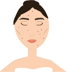 En tecknad kvinna med acne i ansiktet.