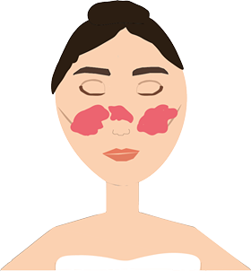 En tecknad kvinna med rosacea i ansiktet. 